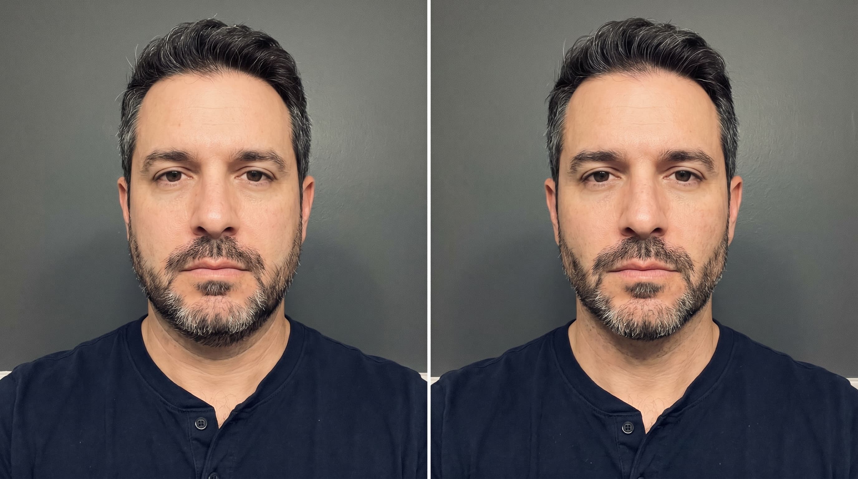 Before and after example: Sharper mandibular angle. Reduced submental fat.