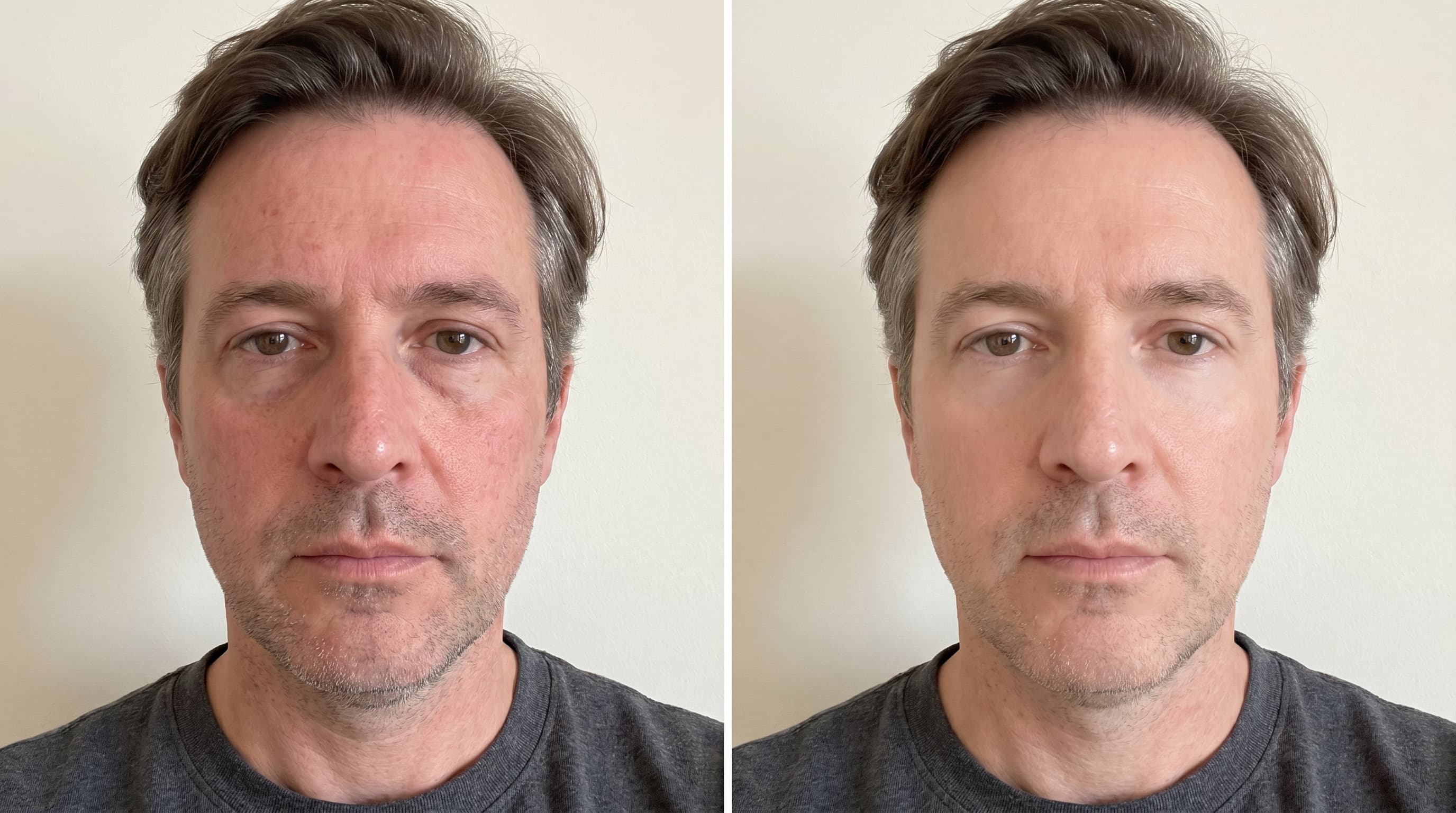 Before and after example: Cleared tone, brighter under-eye, less redness.